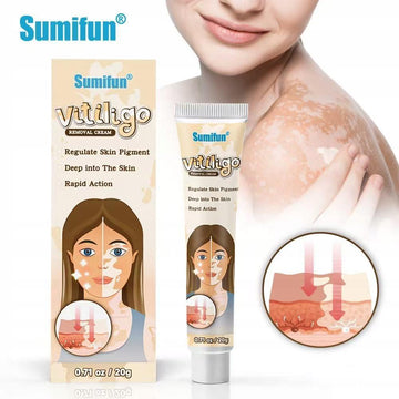 Sumifun Vitiligo Repair Cream – Skin Pigment Care Formula